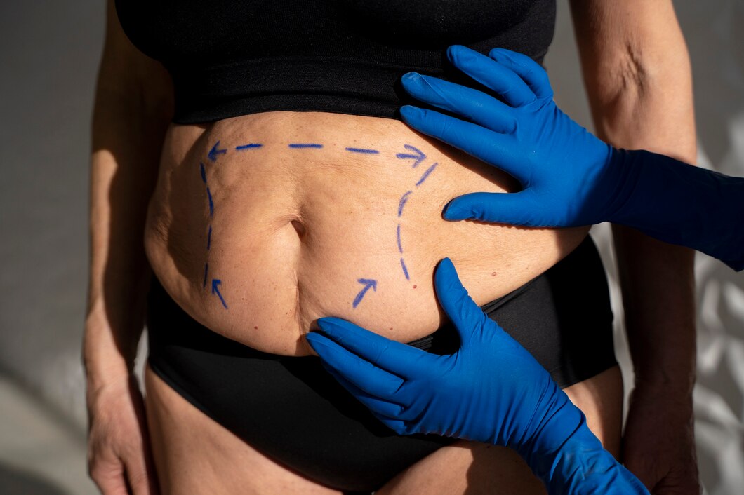 Liposculpture Procedure